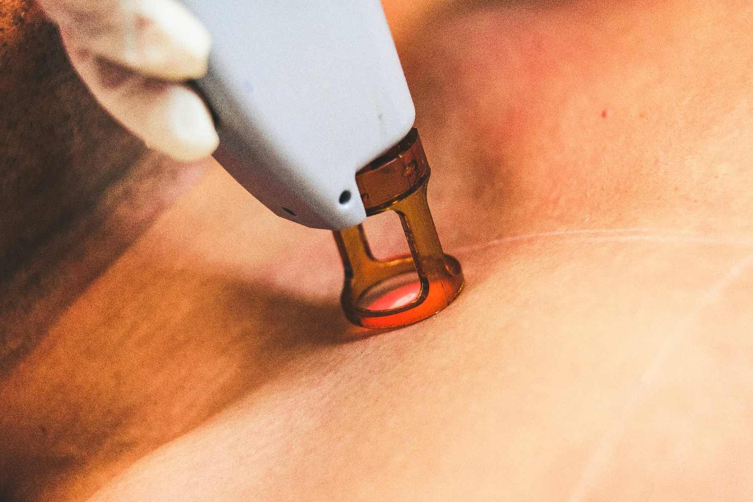 Laser hair removal in Roorkee