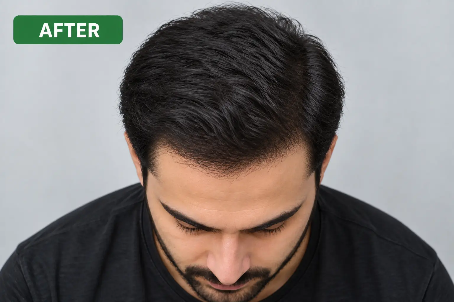 Men's hair transplant before and after result case 2