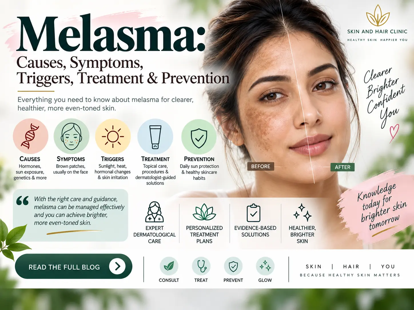 Melasma Causes Symptoms Triggers, Treatment Prevention
